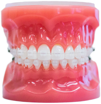 Clear Braces Clear Braces