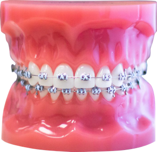 Metal Braces Metal Braces